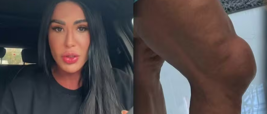 Gracyanne Barbosa mostra joelho inchado e fala sobre impacto de treinos da 'Dança dos Famosos'
